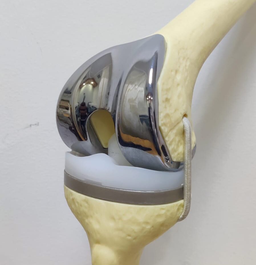 Joint Replacement