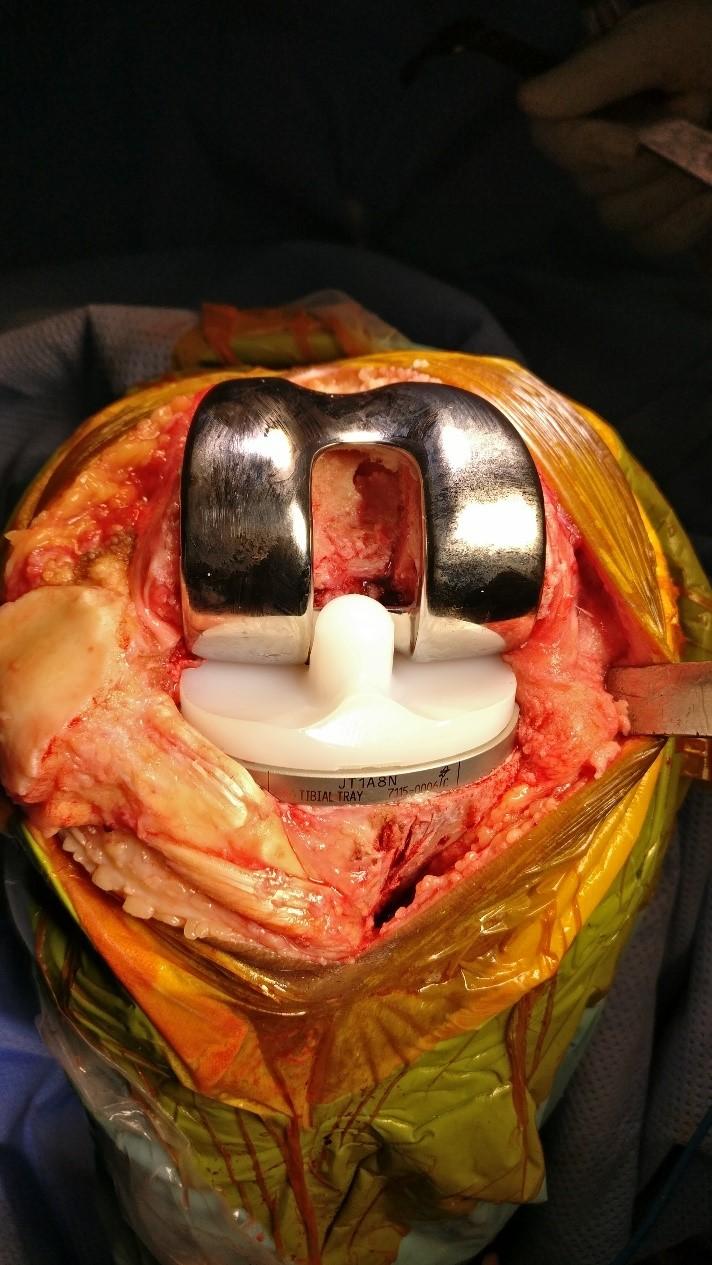 Components of Joint Replacement Surgery