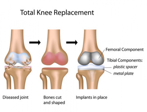 Total knee replacement