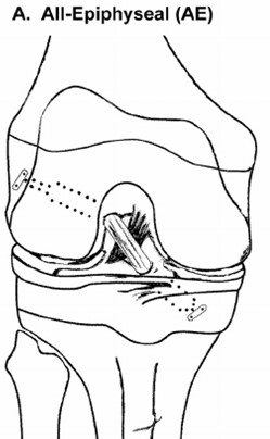 All-Epiphyseal (AE)