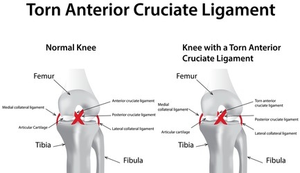 Torn Anterior Cruciate Ligament