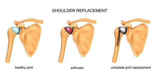 shoulder replacement