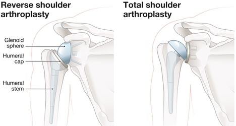total shoulder arthroplasty