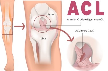 ACL Injury